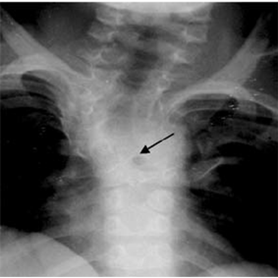 X-Ray Cervico Dorsal Spine Test